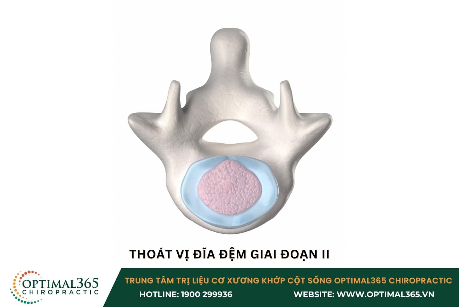 Giai đoạn II: Phình đĩa đệm