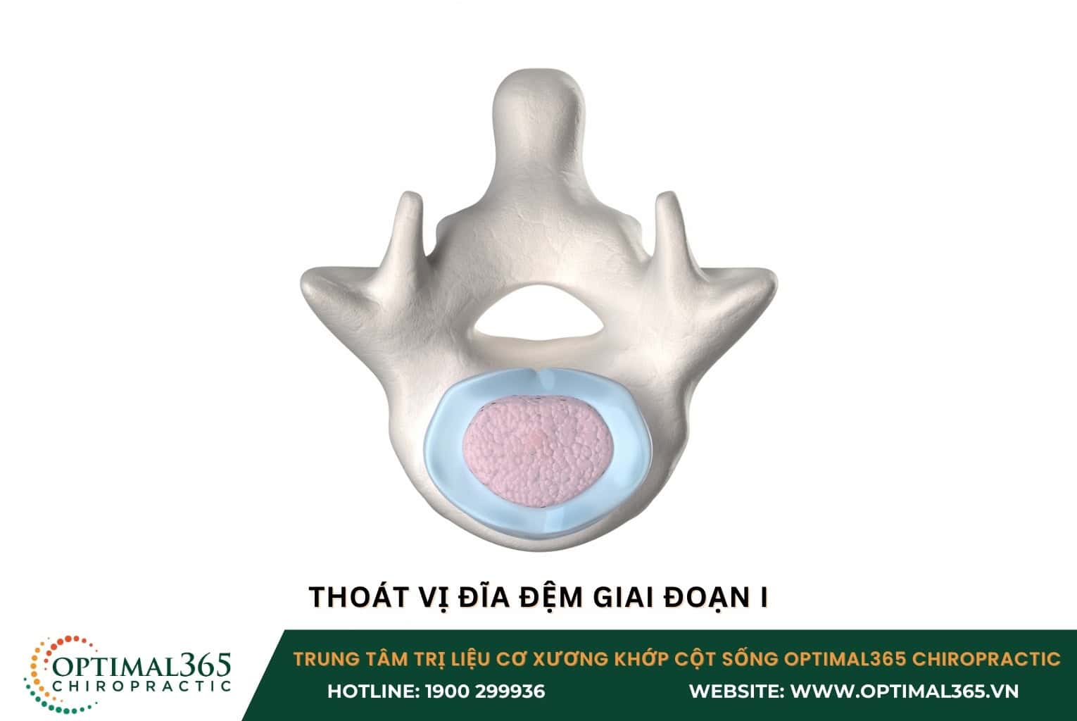 Các giai đoạn của thoát vị đĩa đệm