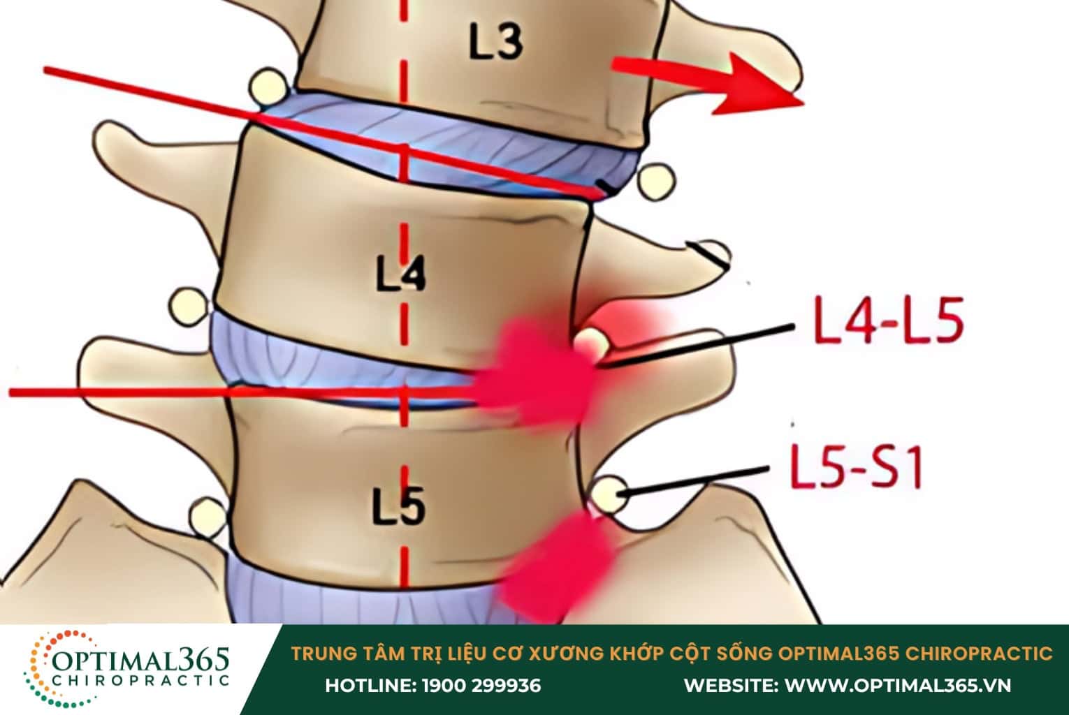 Thoát vị đĩa đệm L4 L5 là gì?