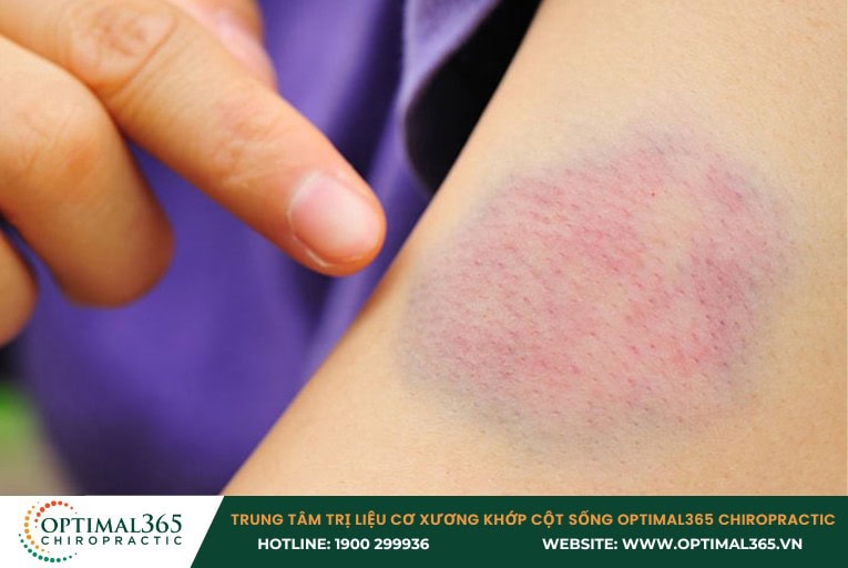 Những rủi ro khi châm cứu chữa thoát vị đĩa đệm