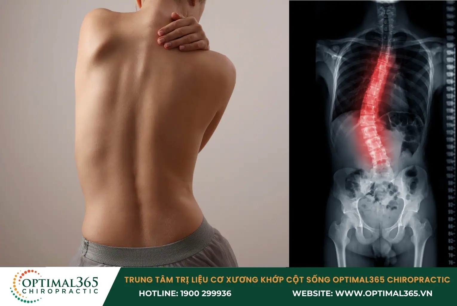 Cong vẹo cột sống chữ C