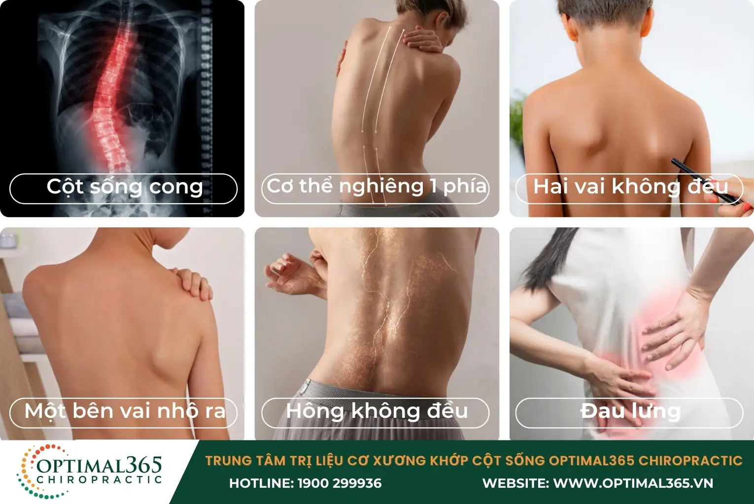 Dấu hiệu nhận biết cong vẹo cột sống