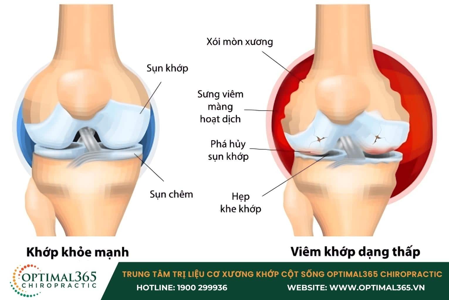 Tình trạng mãn tính: Dấu hiệu bệnh lý xương khớp