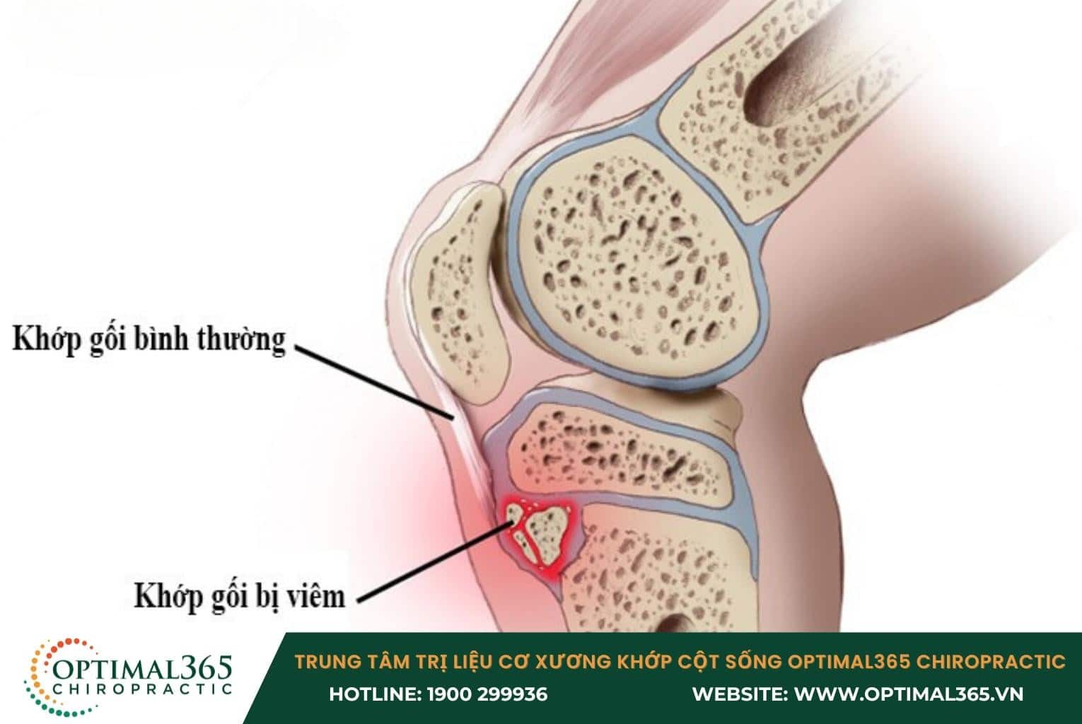 Tổn thương cơ bản: Chấn thương đầu gối