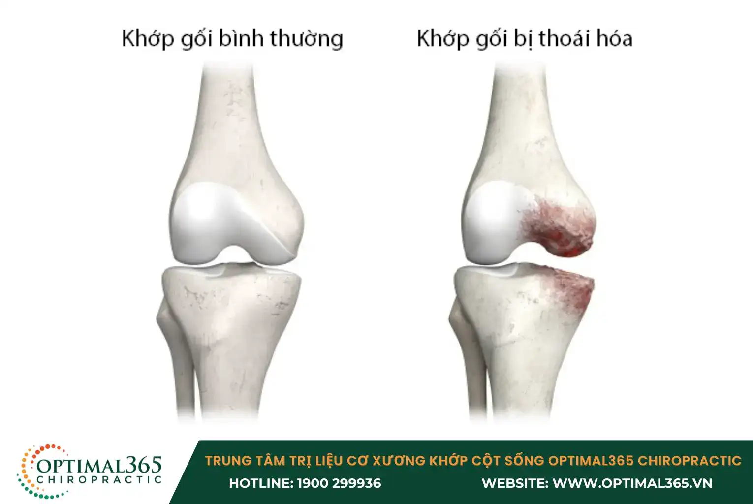 Tuổi càng cao, quá trình lão hóa càng diễn ra nhanh, sụn khớp càng dễ bị mòn