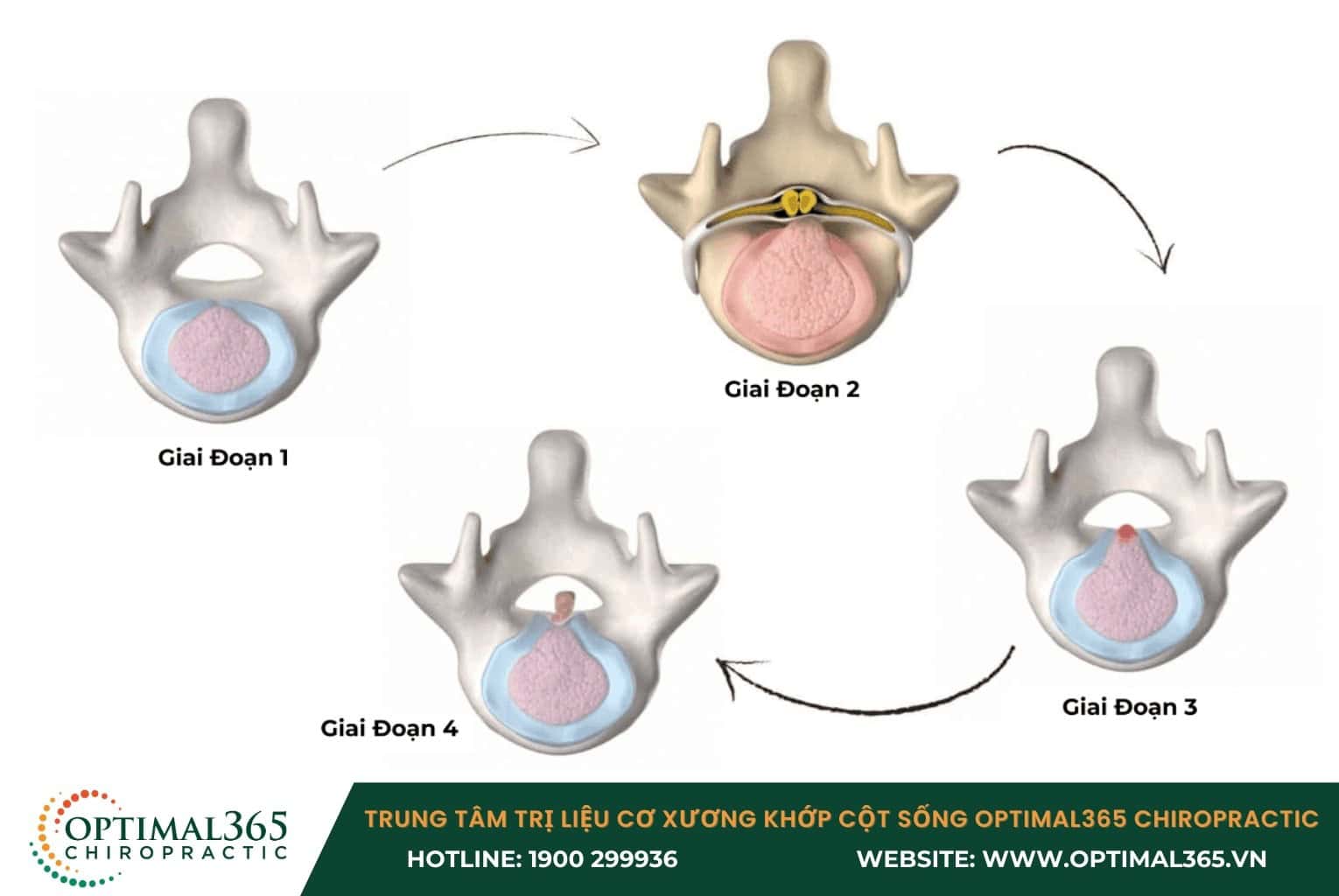 Các giai đoạn của bệnh thoát vị đĩa đệm