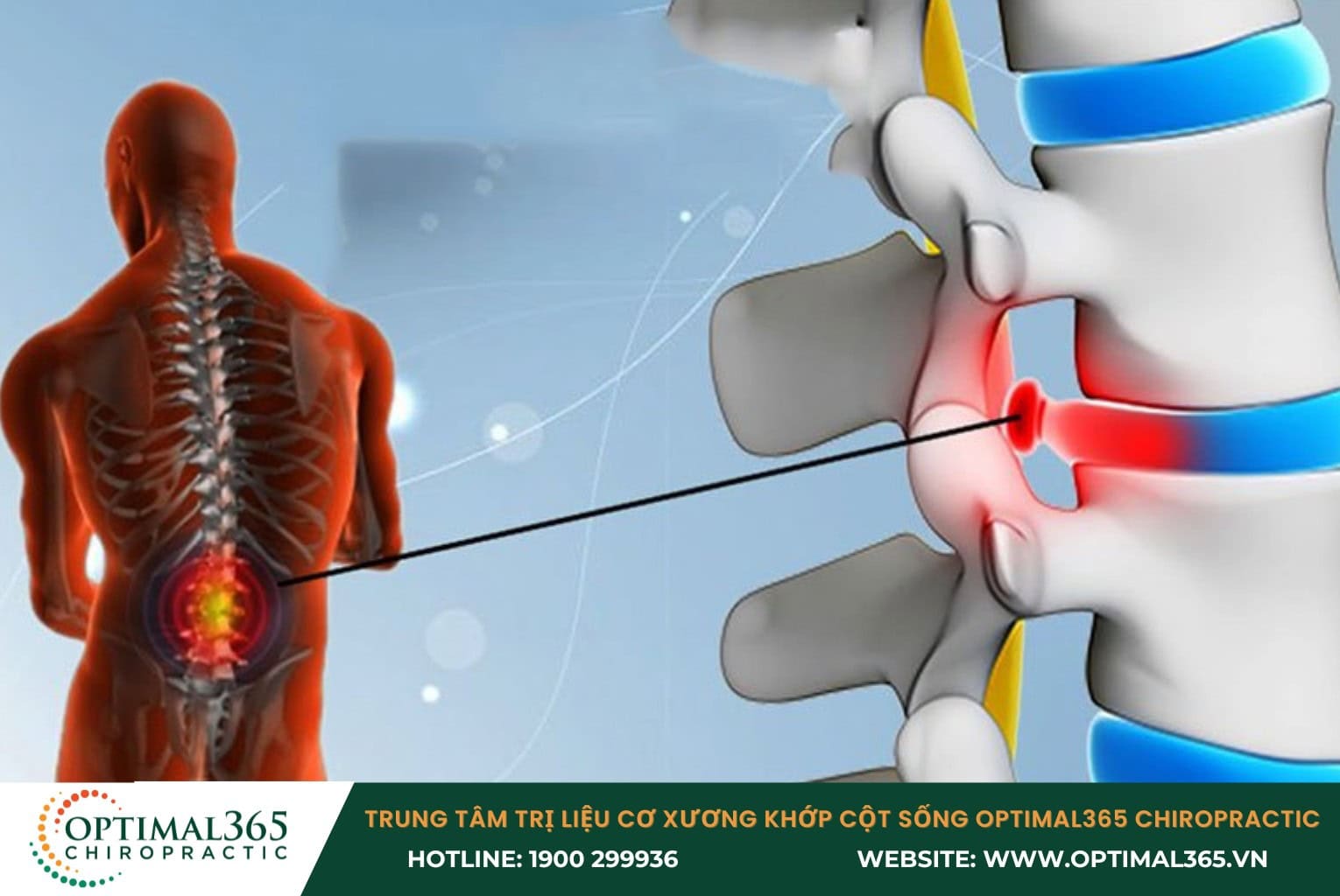 Nguyên nhân gây lồi đĩa đệm