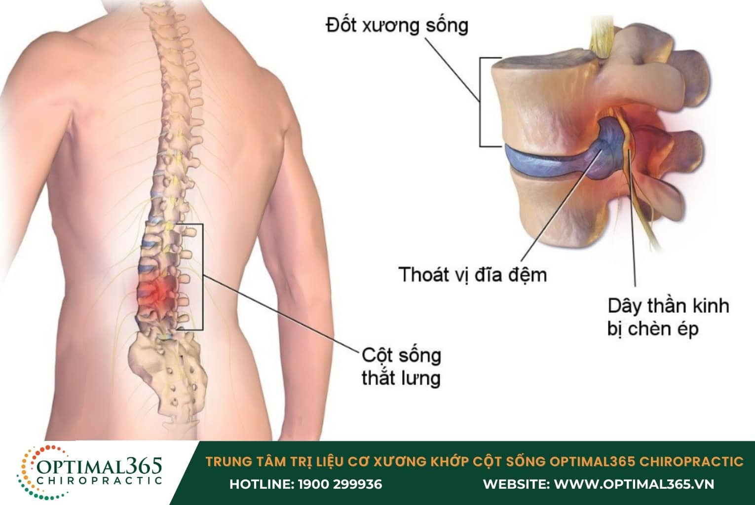 Tổng quan tình trạng thoát vị đĩa đệm chèn dây thần kinh