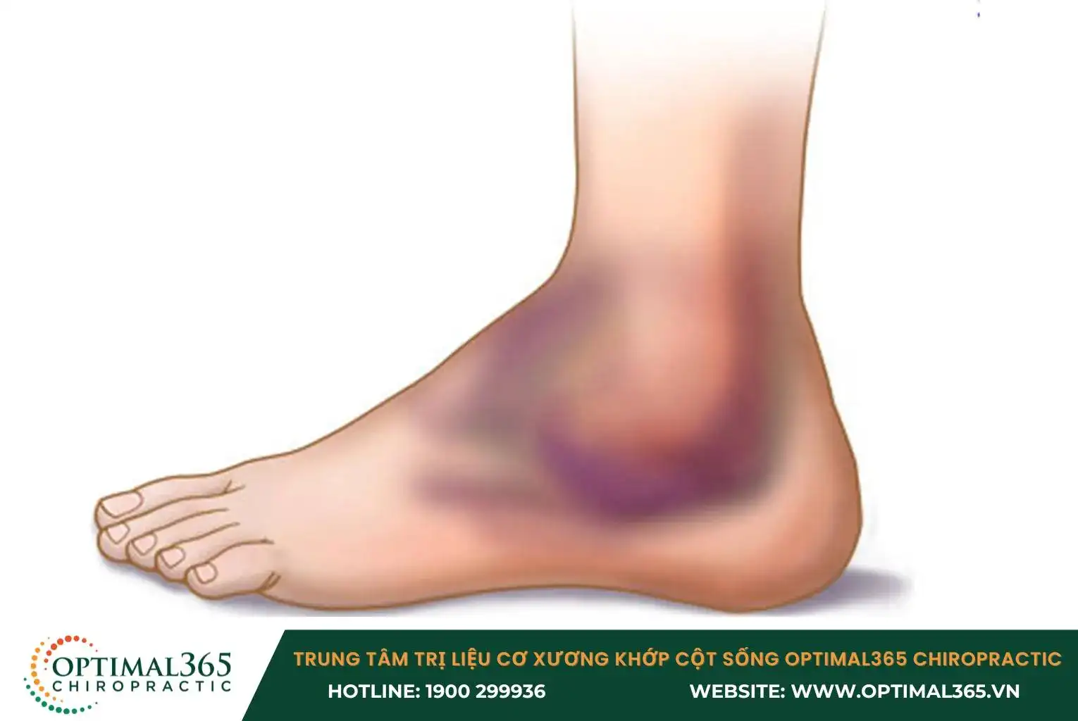 Khi di chuyển khớp cổ chân, bạn có thể cảm thấy khớp bị lỏng lẻo hoặc không ổn định