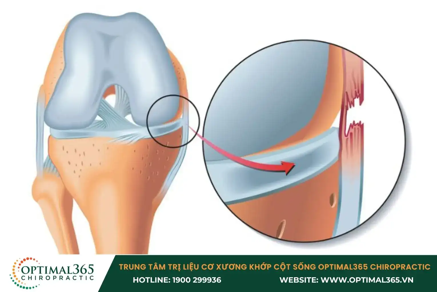 Chấn thương dây chằng trong khớp gối do chịu lực tác động đột ngột