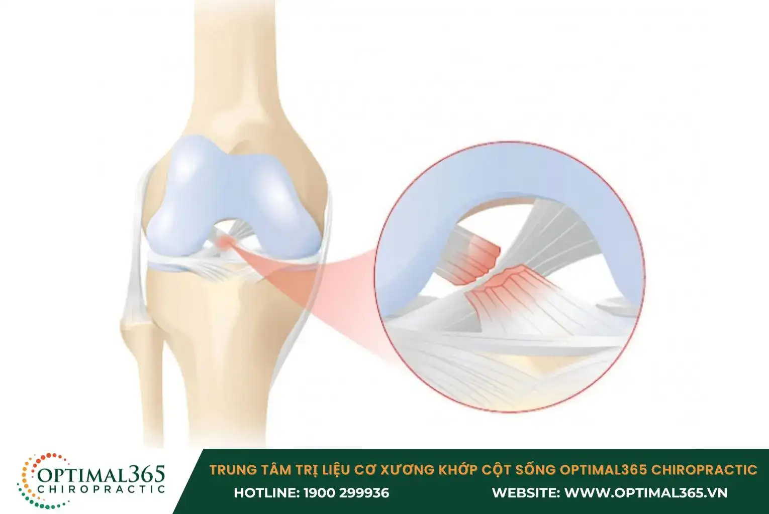 Chấn thương đầu gối dây chằng chéo sau do đầu gối bị va chạm mạnh