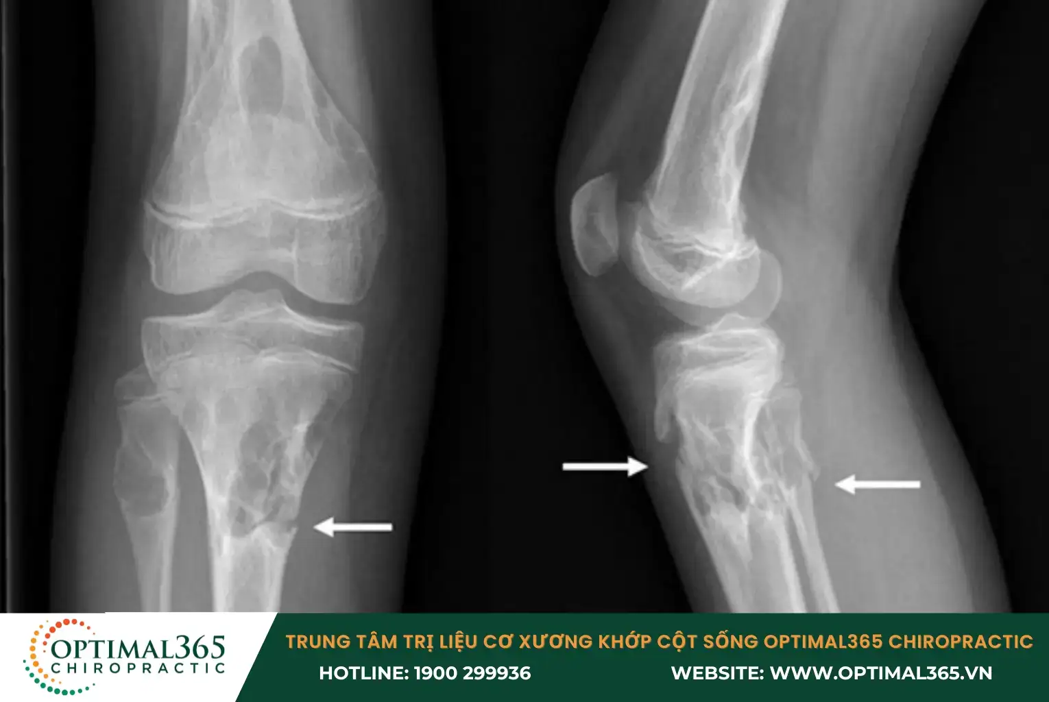 Hình ảnh X quang chẩn đoán giãn dây chằng khớp gối