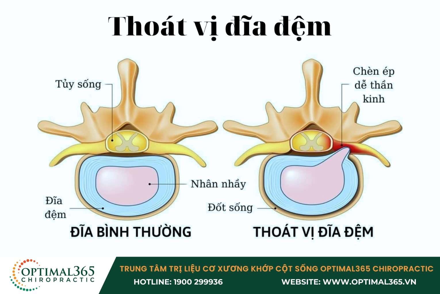 Thoát vị đĩa đệm cổ
