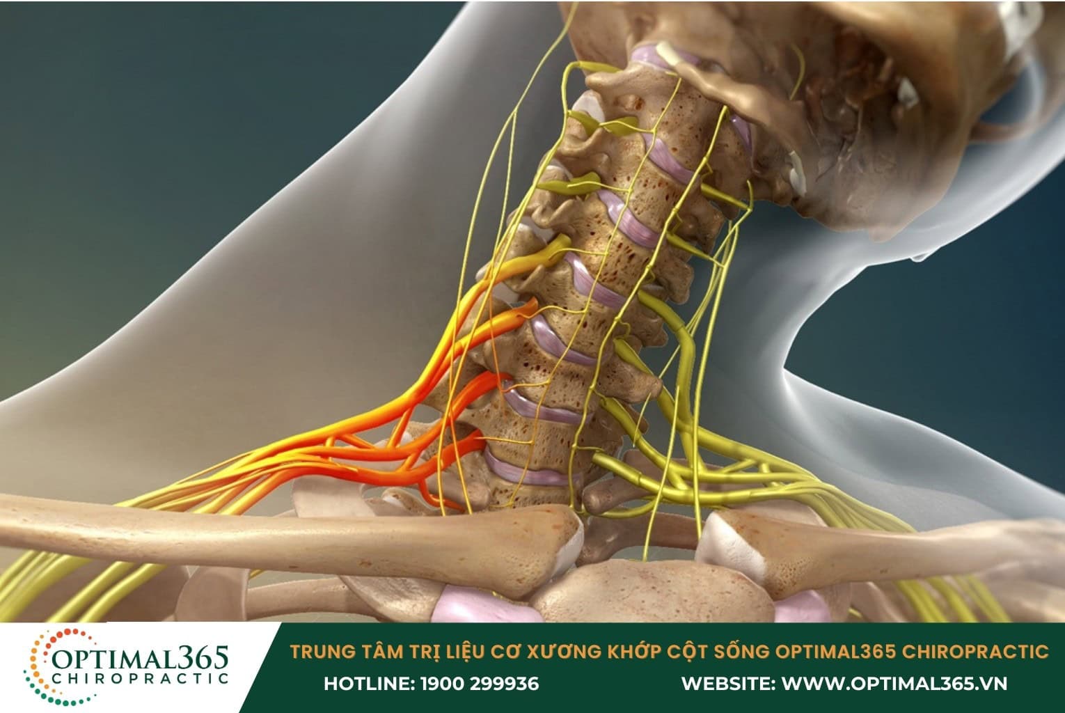 Đau dây thần kinh vai gáy là gì?