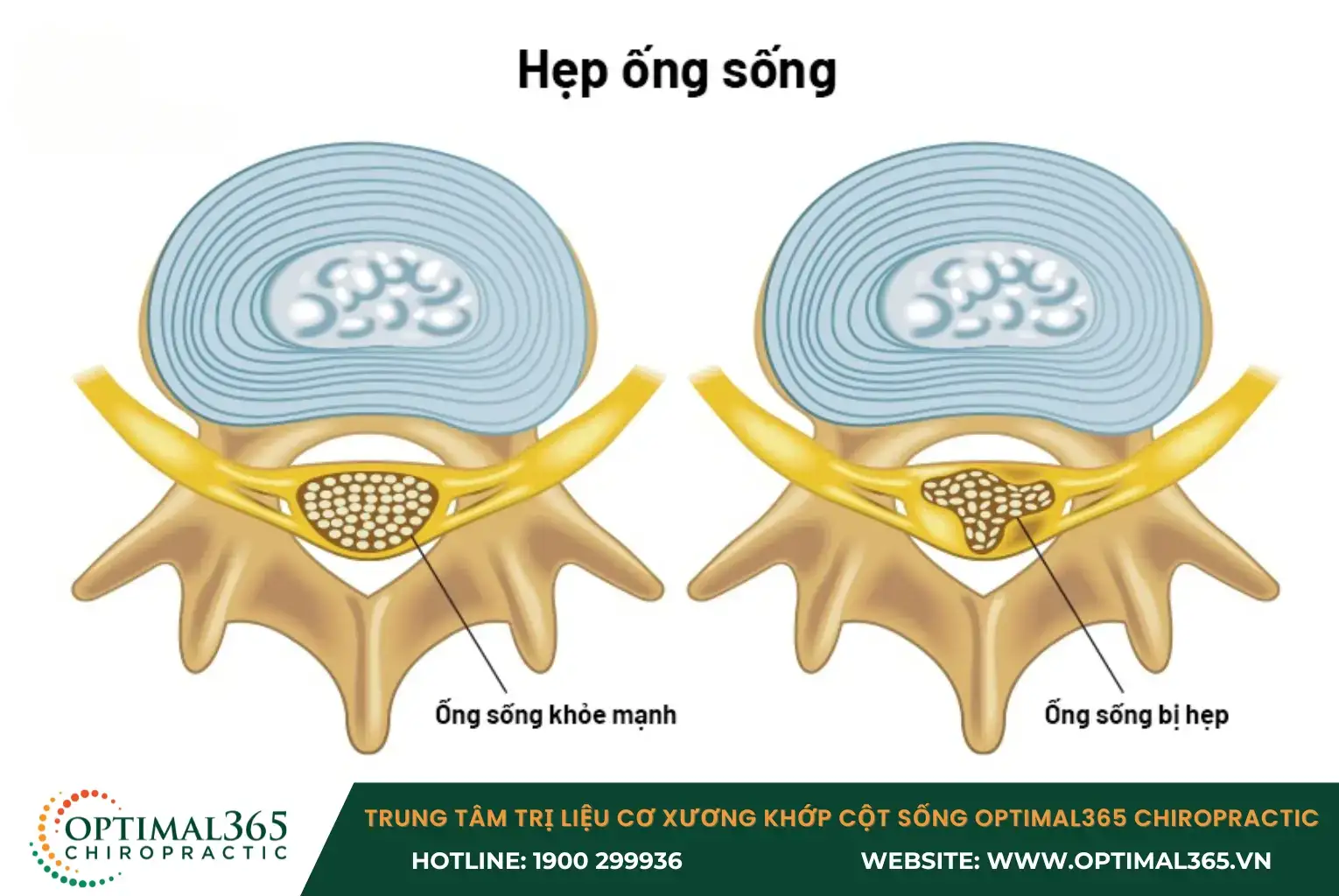Hẹp ống sống cổ gây ra những hậu quả lâu dài nếu không được điều trị kịp thời