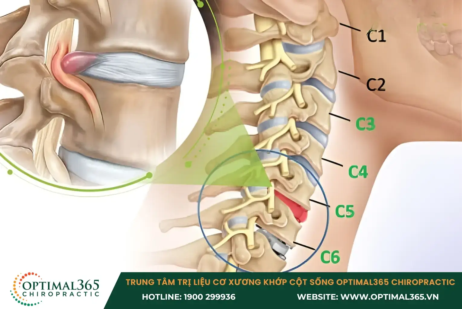 Gai đốt sống cổ xảy ra khi các khớp xương ở cột sống cổ bị thoái hóa
