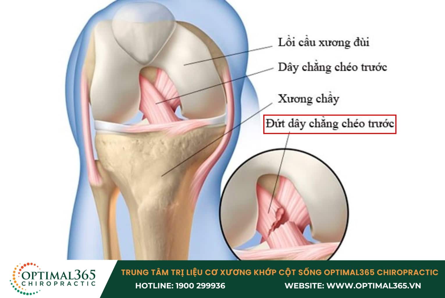 Khi bị chấn thương ACL, dây chằng có thể bị giãn, rách một phần hoặc rách hoàn toàn
