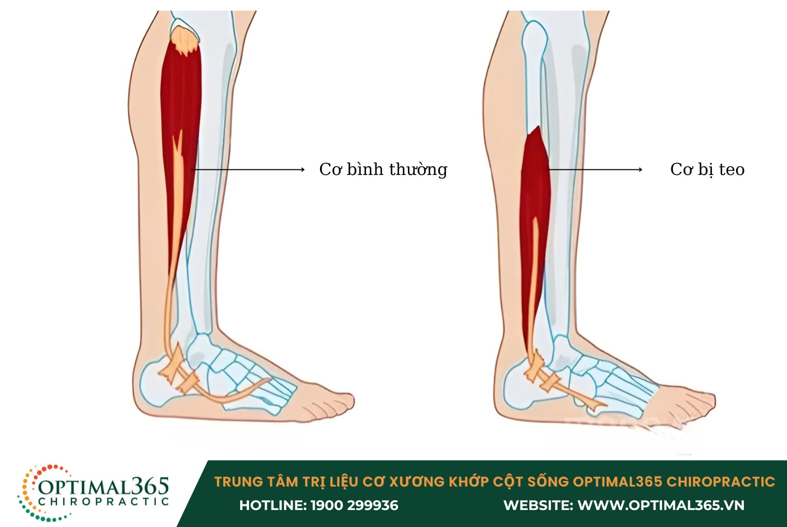 Chấn thương dây chằng đầu gối thường dẫn đến tình trạng teo cơ đùi