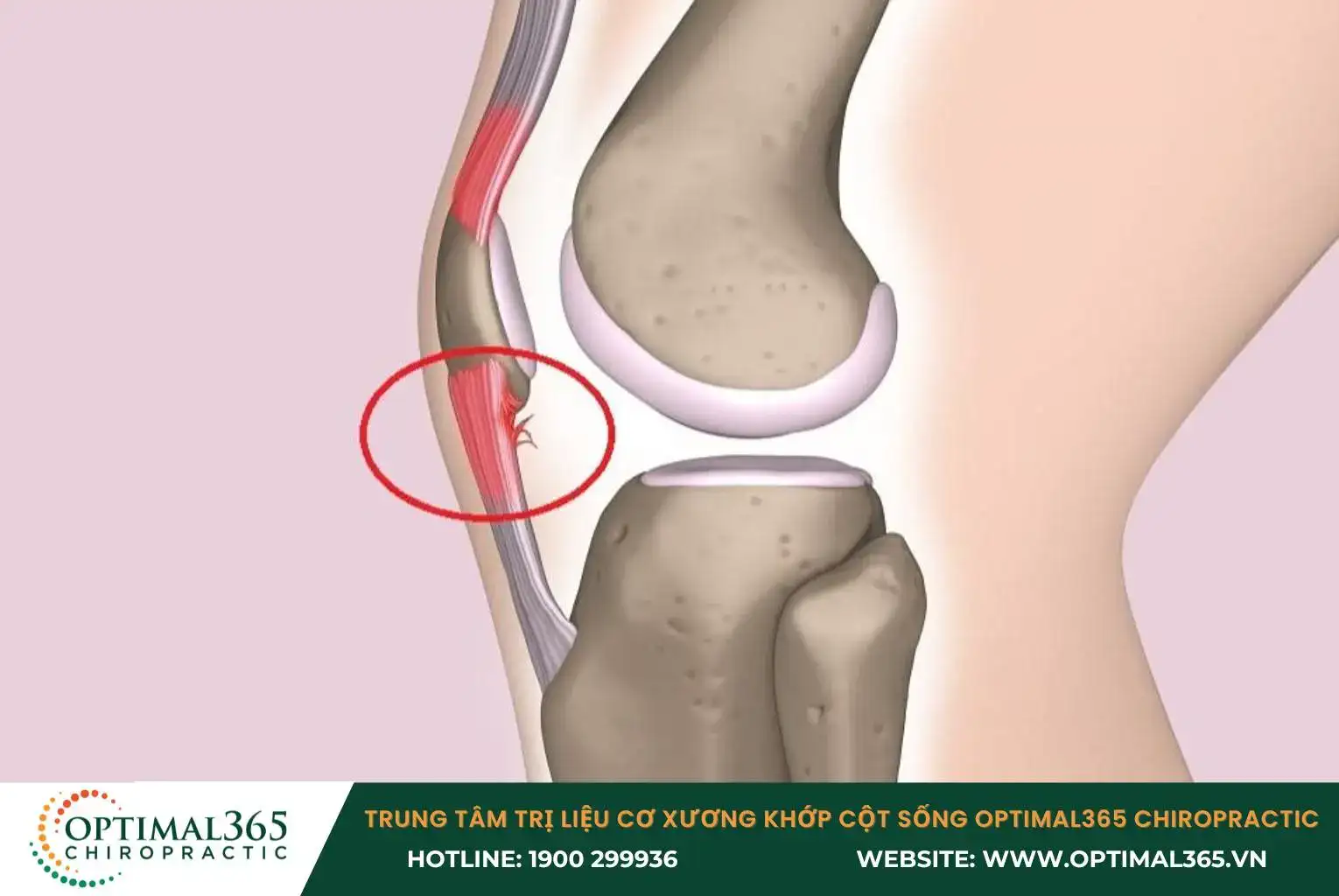  Patellar tendonitis is commonly seen in runners and cyclists