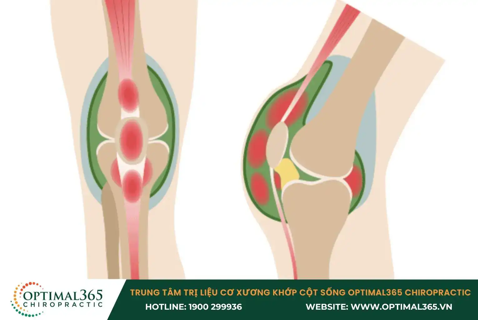 Bursitis of the knee causes pain and swelling in the joint