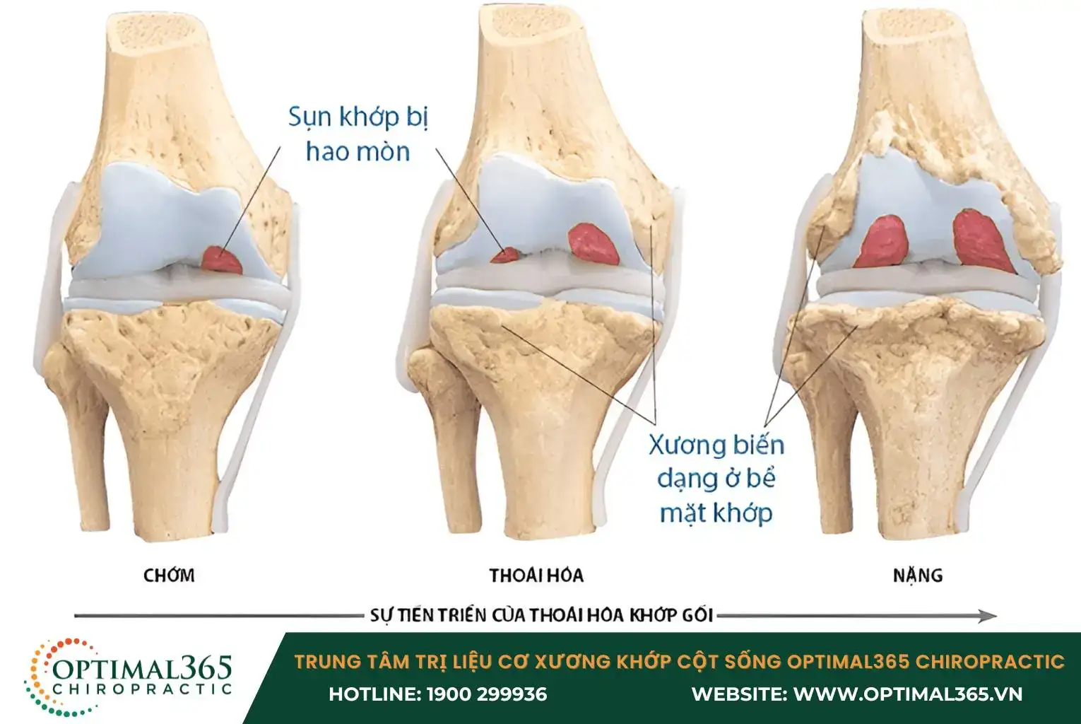 Degeneration of the knee joint leads to inflammation and pain in the knee