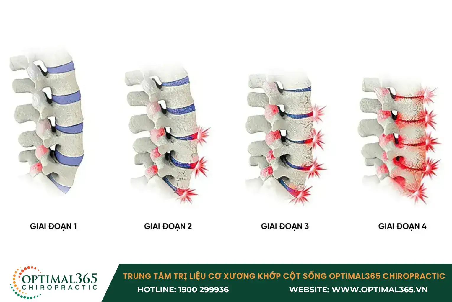 4 Stages of Spinal Degeneration