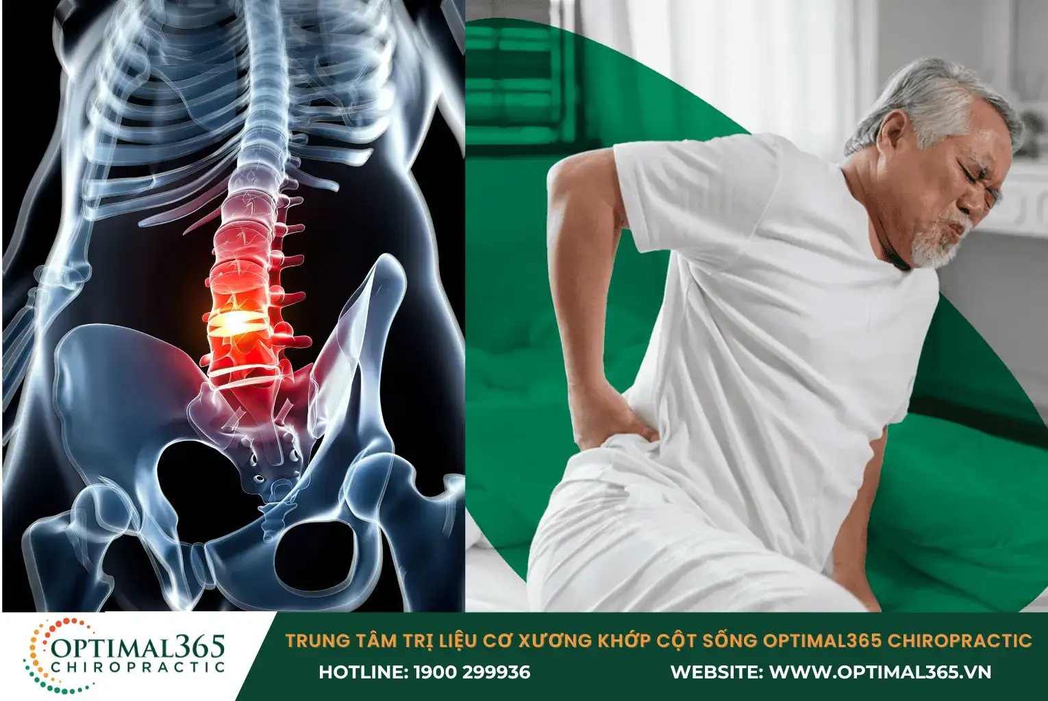 Spondylosis is a condition in which the vertebrae wear down and cause inflammation