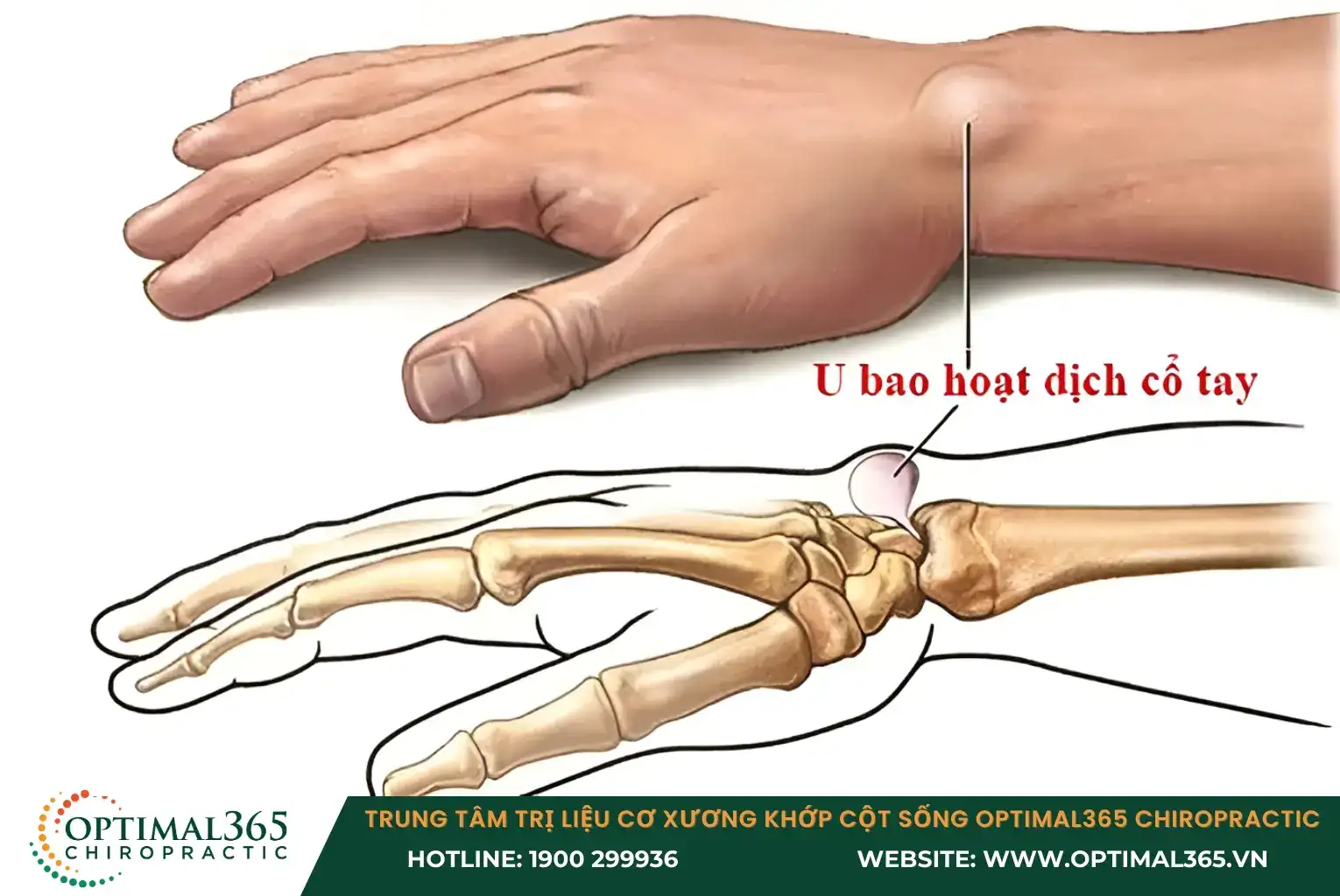 Ganglion Cyst: A ganglion cyst is a benign tumor that forms due to the swelling of the synovial sheath surrounding the joints.
