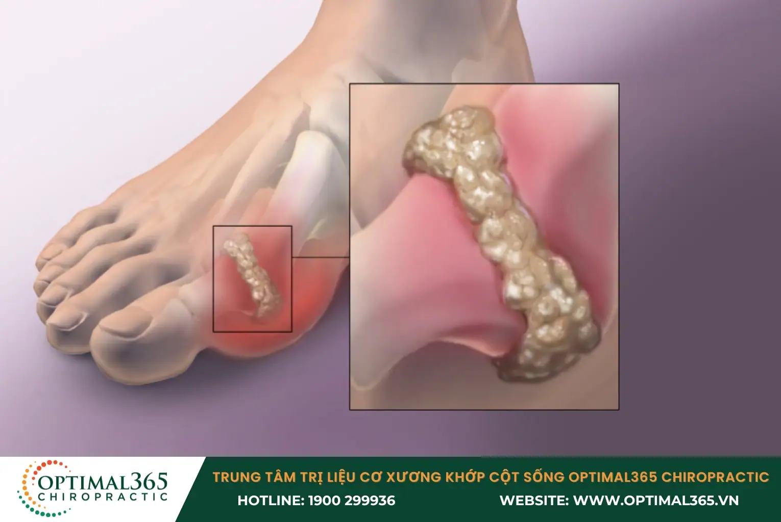 Bệnh gout gây đau đột ngột, sưng đỏ, nóng khớp