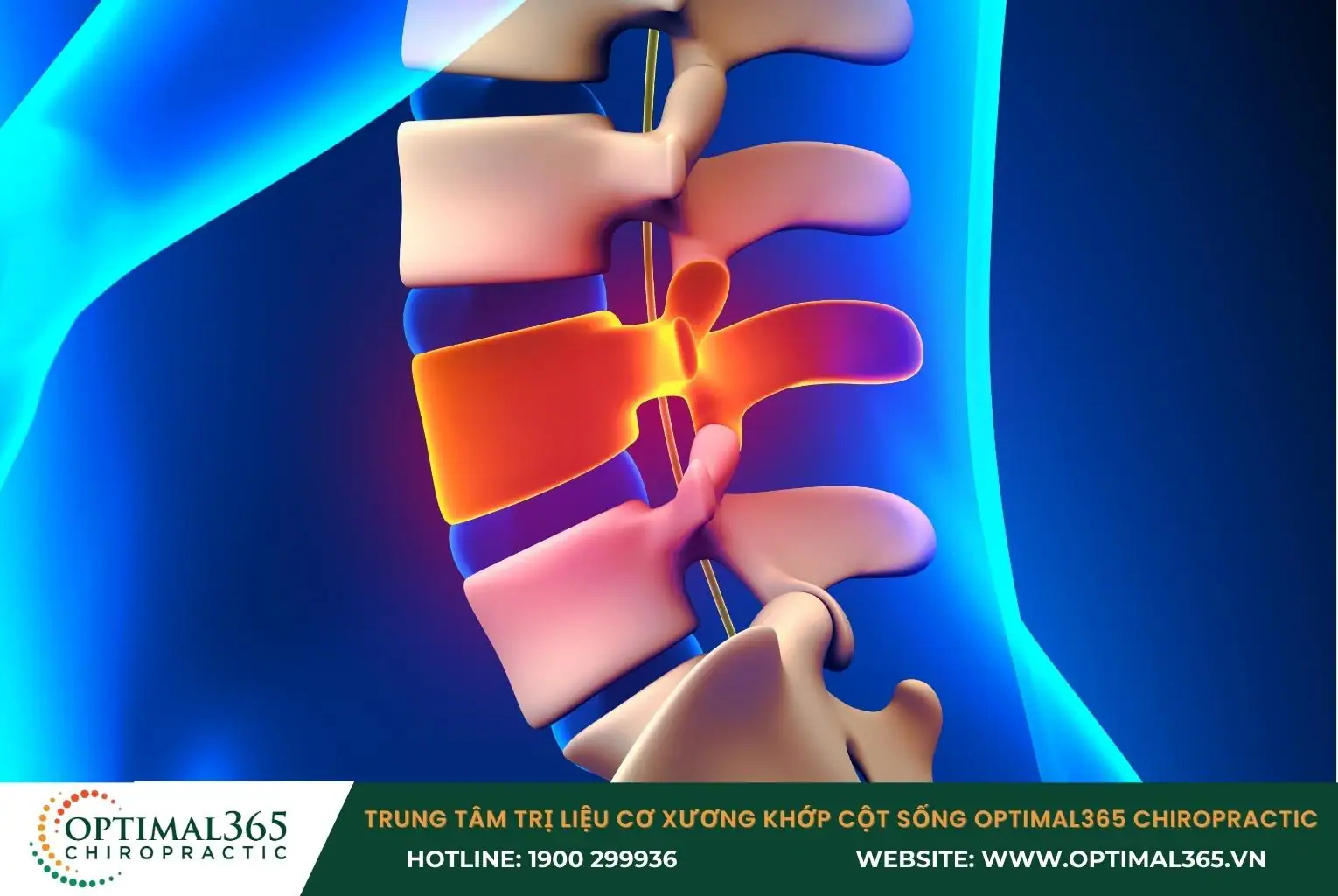 Gai cột sống gây cơn đau nhức dai dẳng do chèn ép thần kinh