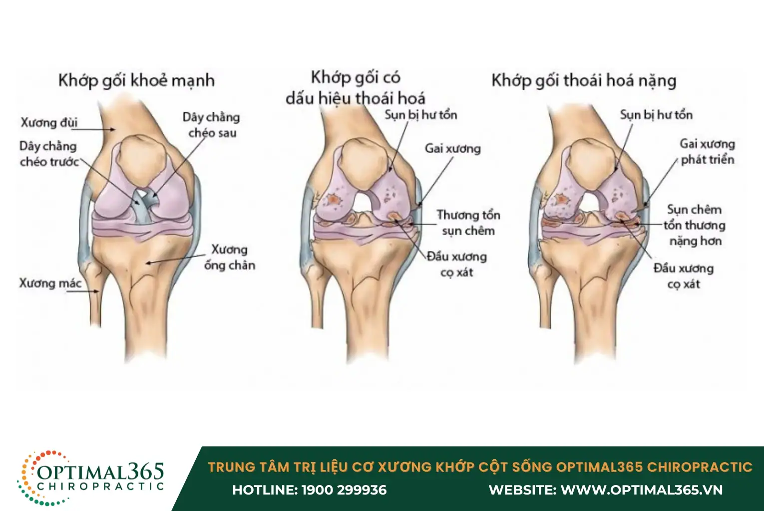 Thoái hóa khớp là tình trạng sụn khớp và xương dưới dưới sụn bị tổn thương