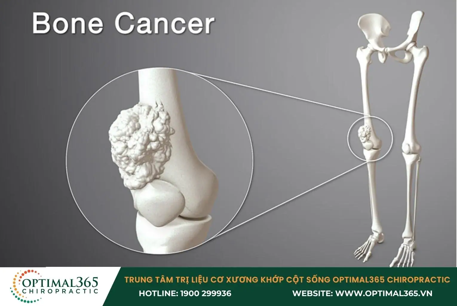 Ung thư xương là bệnh hiếm gặp, có độ nguy hiểm cao