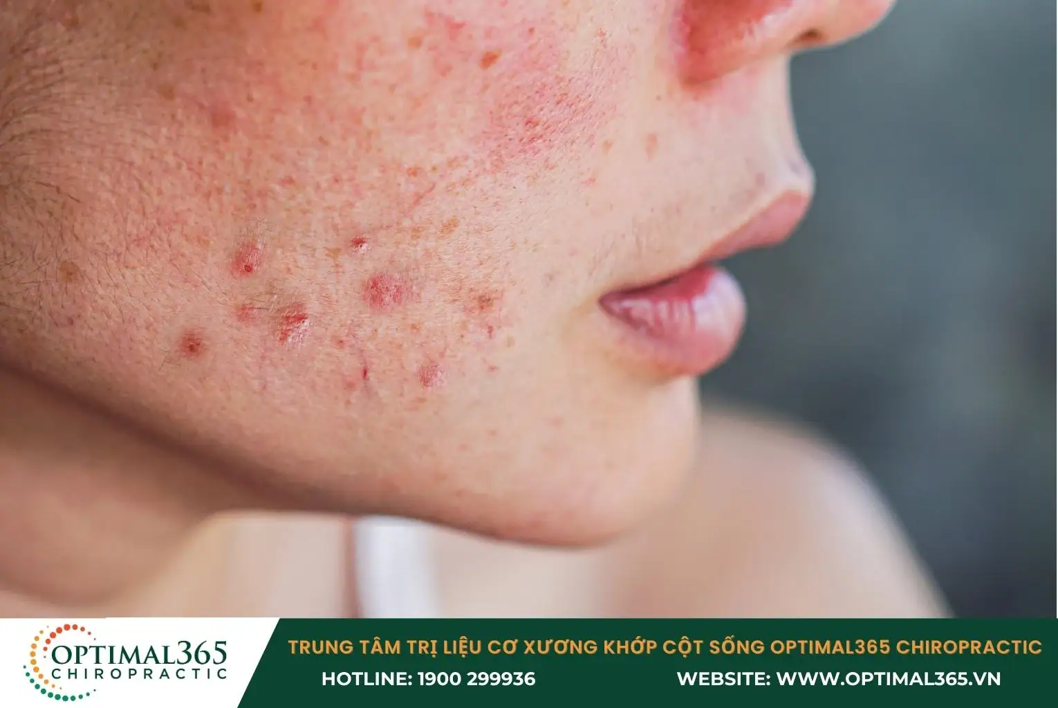Phát ban trên da là triệu chứng phổ của lupus ban đỏ hệ thống