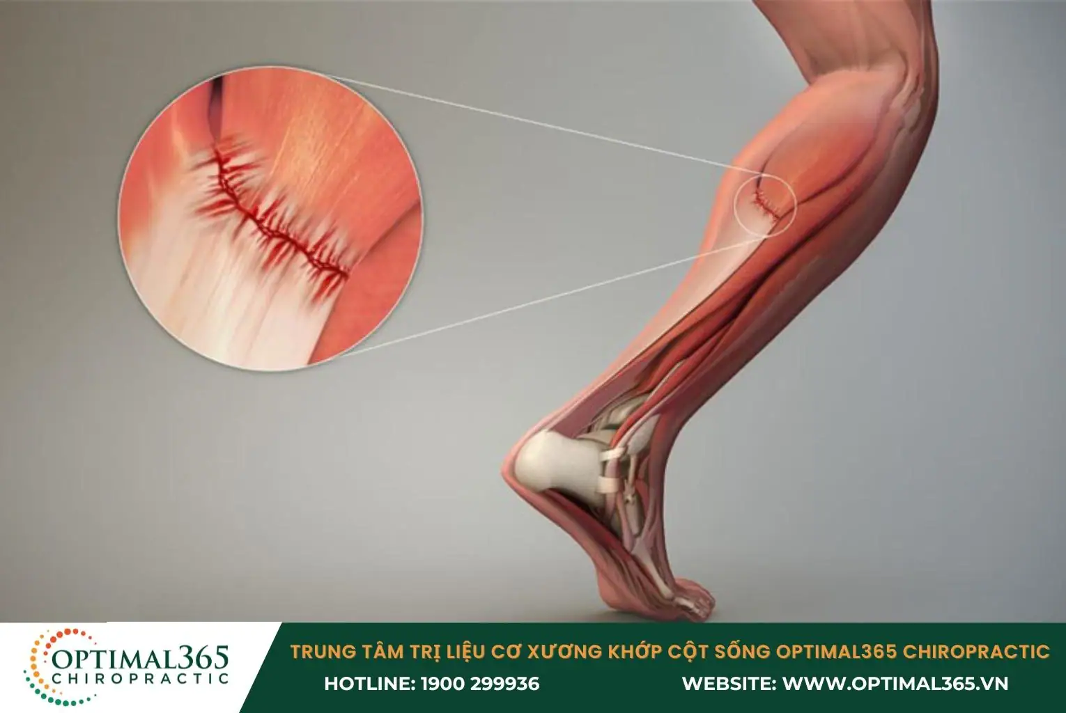 Căng cơ bắp chân gây đau nhức và hạn chế khả năng vận động của chân