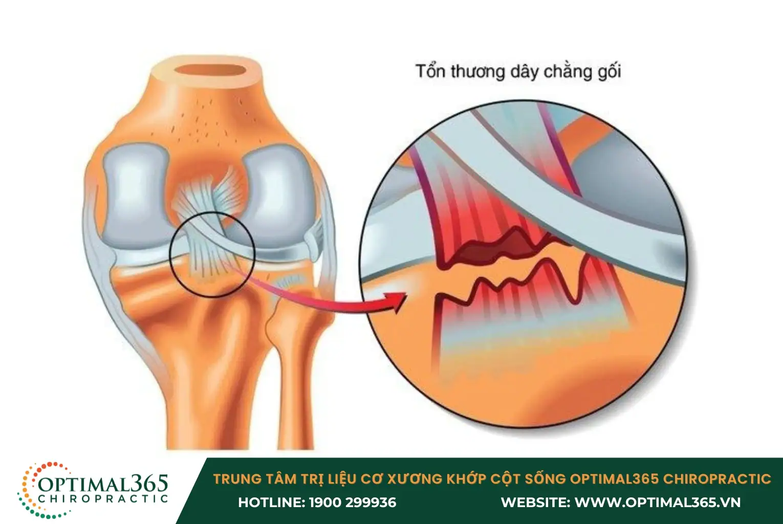 Dây chằng chéo dễ bị tổn thương khi cầu thủ đổi hướng đột ngột