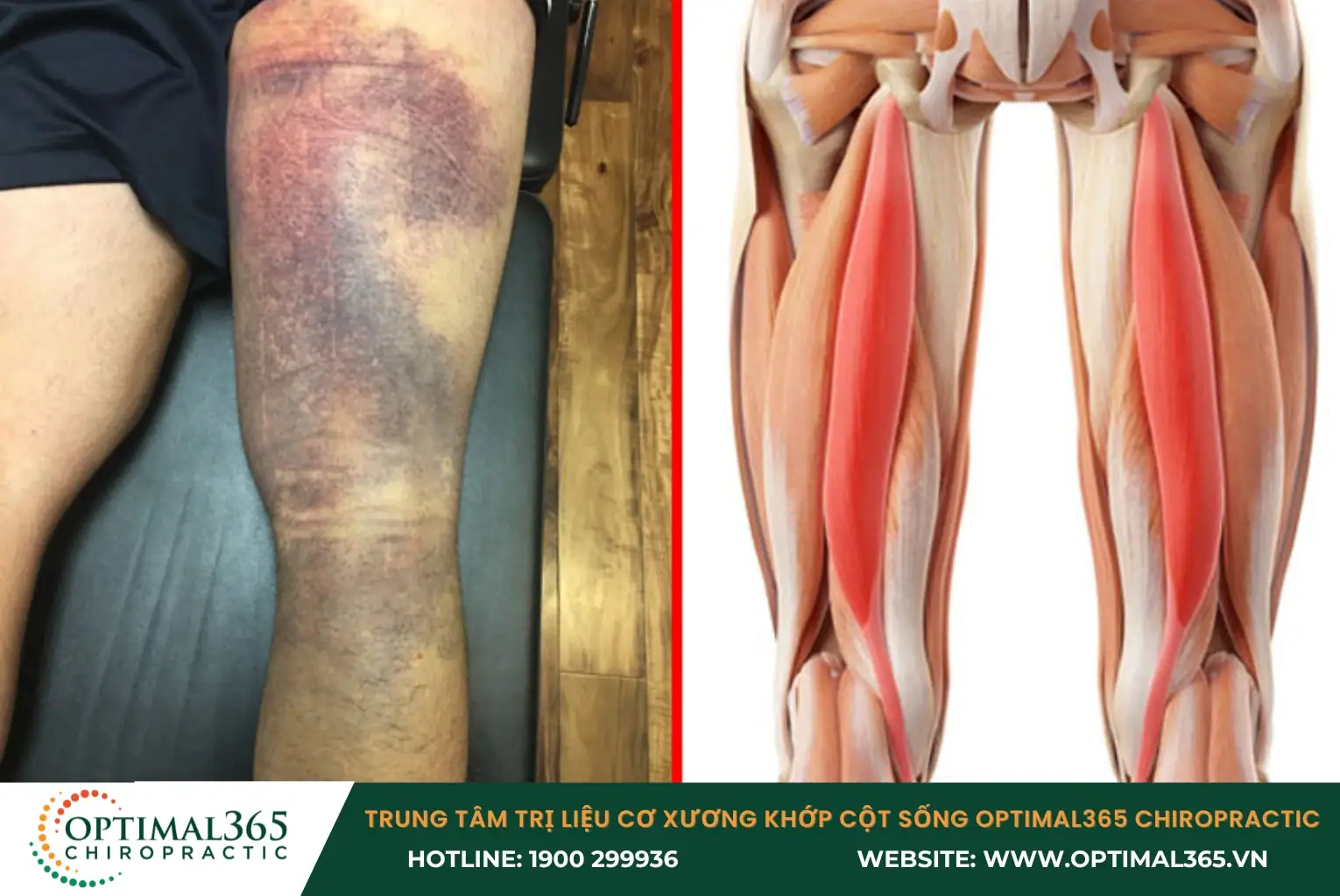 Chấn thương gân kheo do va chạm, té ngã đột ngột trong quá trình vận động