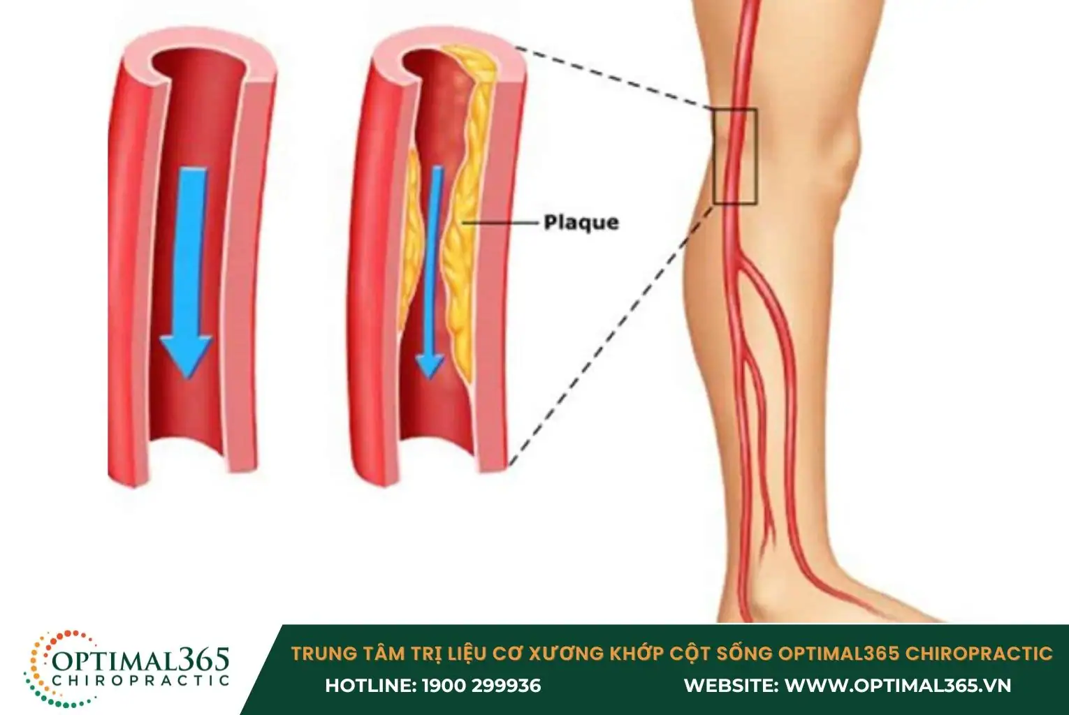 Bệnh động mạch chi dưới gây nên cơn đau bắp chân