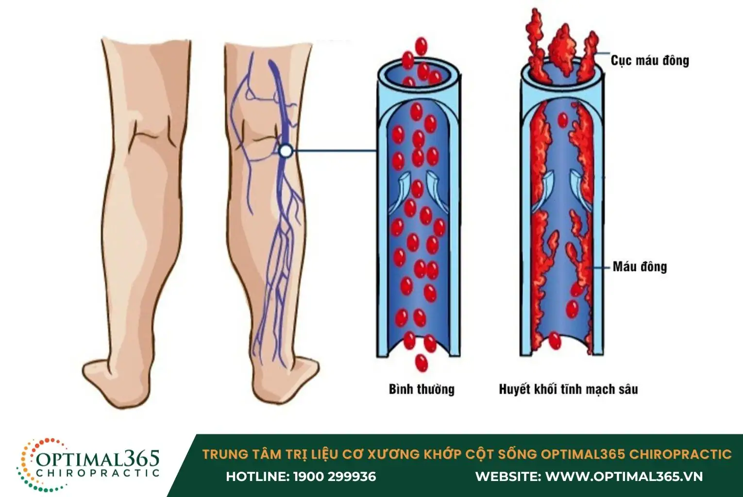 Huyết khối tĩnh mạch sâu khiến máu không thể lưu thông gây đau nhức bắp chân