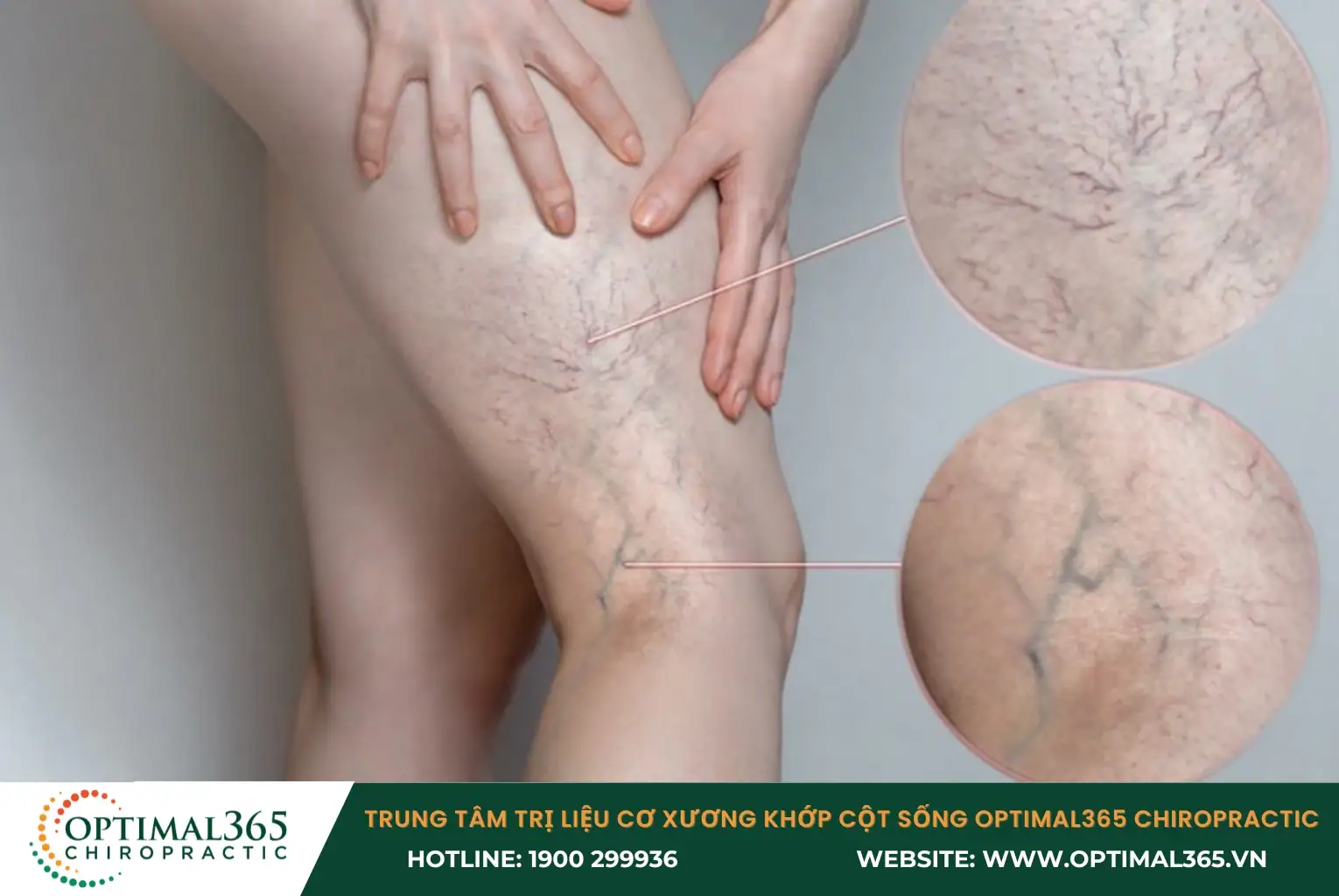 Suy giãn tĩnh mạch chi dưới sẽ dẫn đến triệu chứng đau bắp chân