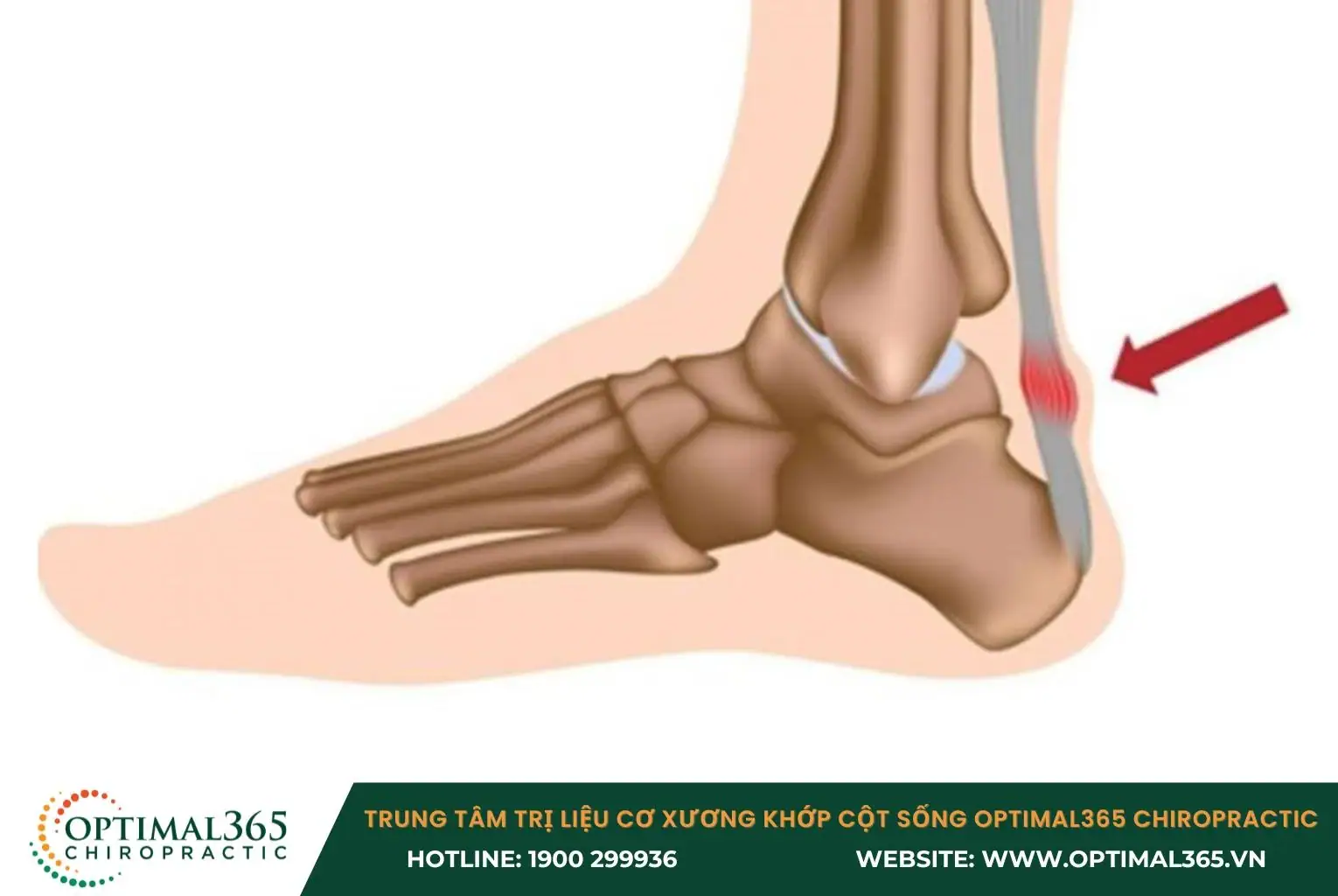 Viêm gân Achilles là một trong những nguyên nhân gây đau bắp chân