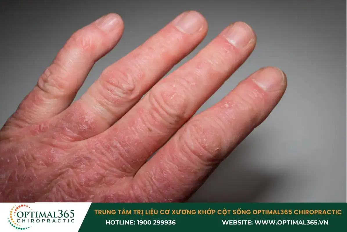 Viêm khớp vảy nến gây đau nhức, sưng phù các khớp