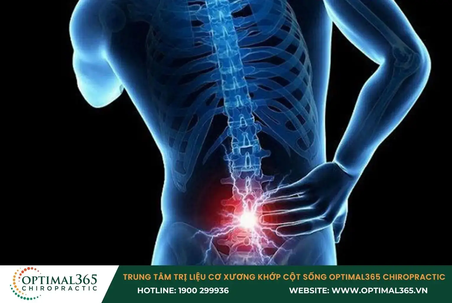 Gai cột sống L4 L5 do lắng đọng canxi quá mức