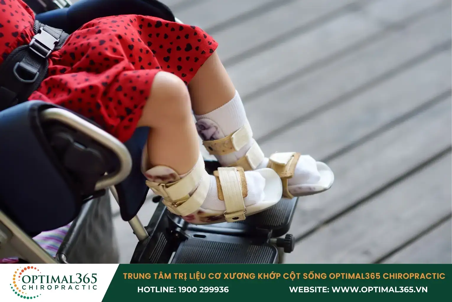 Tổn thương thần kinh có thể gây liệt các chi