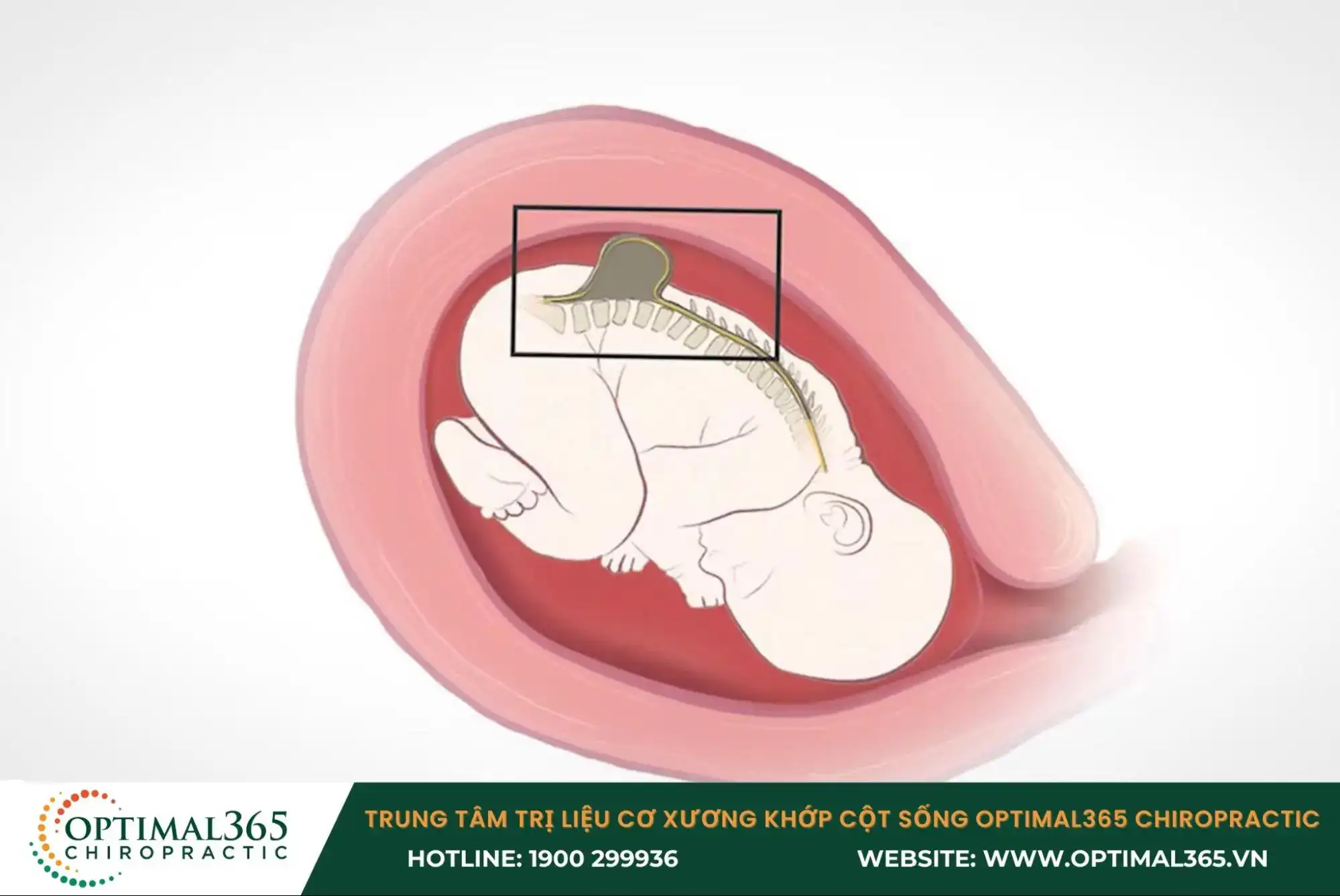 Bệnh gai đôi cột sống bẩm sinh tiến triển trong thai kỳ khi mẹ bầu không chú trọng sức khỏe hoặc do di truyền