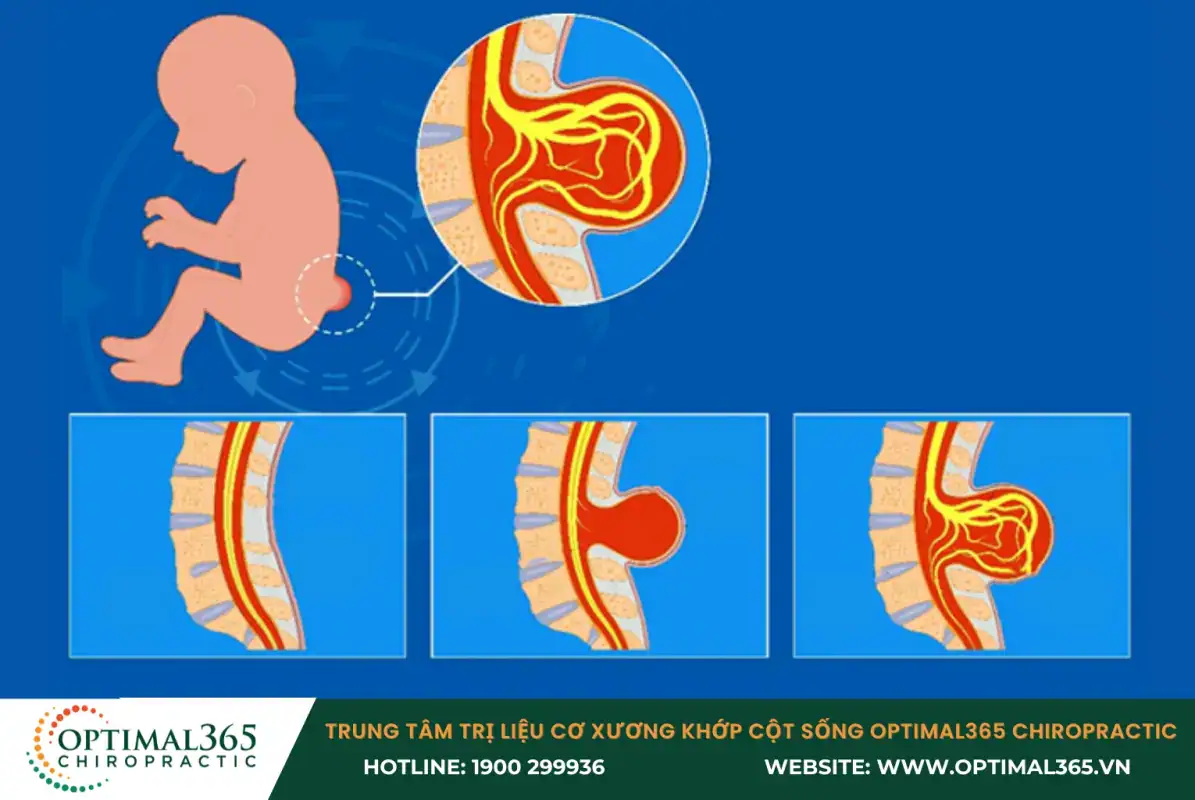 Bệnh gai đôi cột sống S1 ảnh hưởng tới các cơ quan và mô tại lưng