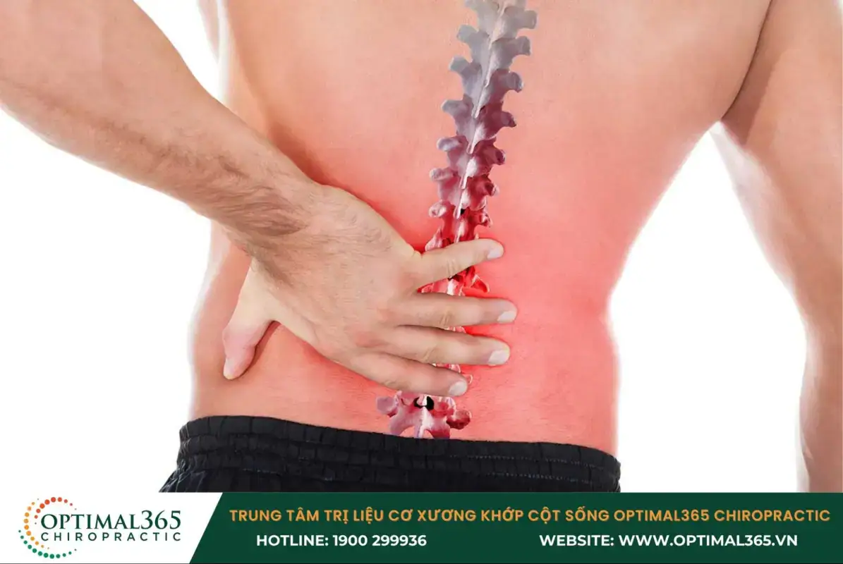 Cơn đau thắt lưng là dấu hiệu điển hình của gai đôi cột sống S1 ở người lớn