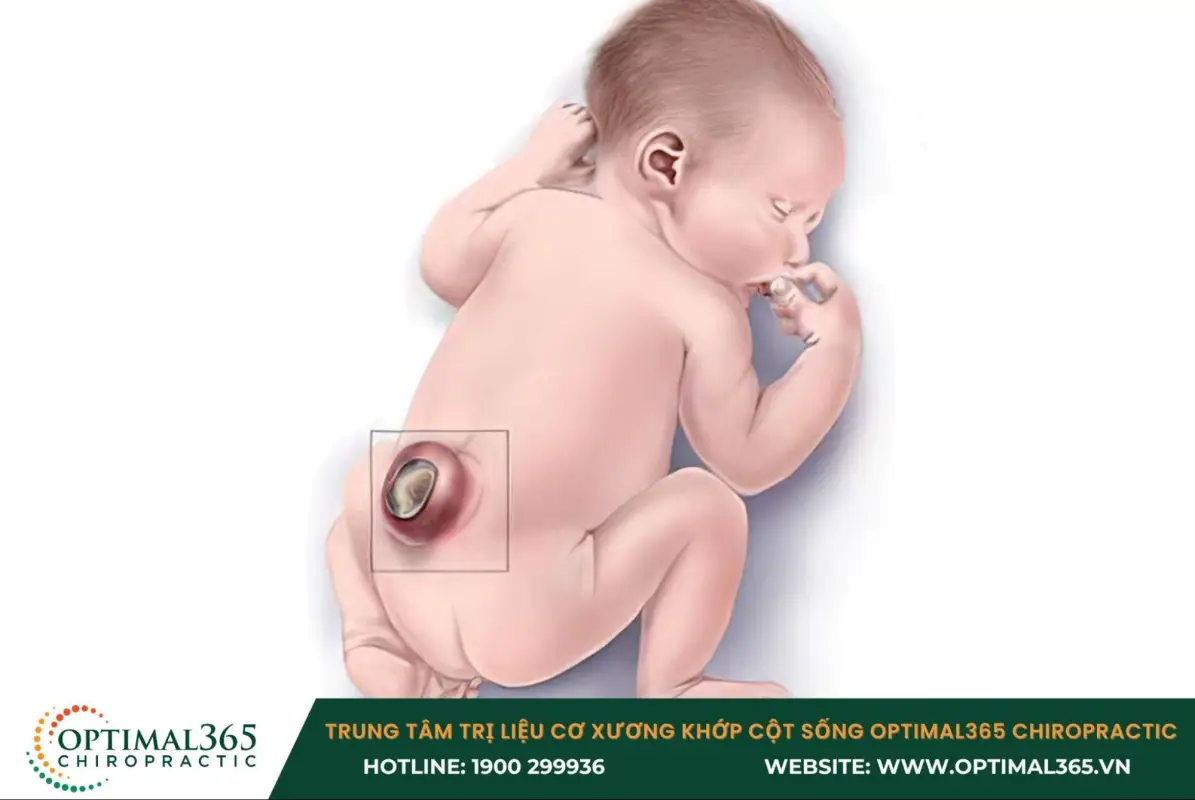 Bệnh gai đôi cột sống S1 ở trẻ thường dẫn đến rối loạn hô hấp