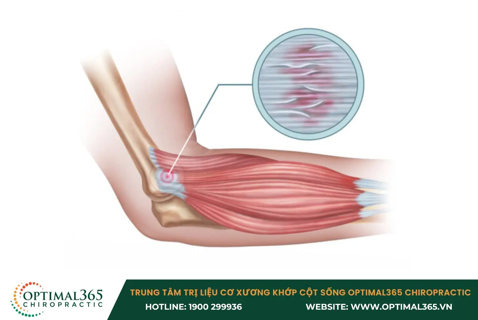 Tình trạng viêm và sưng tấy có thể gây tê bì, ngứa ran hoặc cảm giác yếu ở cánh tay và bàn tay