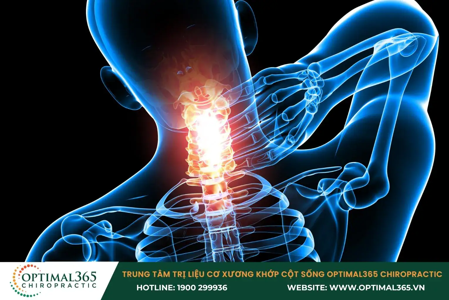 Thoát vị đĩa đệm là nguyên nhân phổ biến gây đau nửa đầu kèm vai gáy