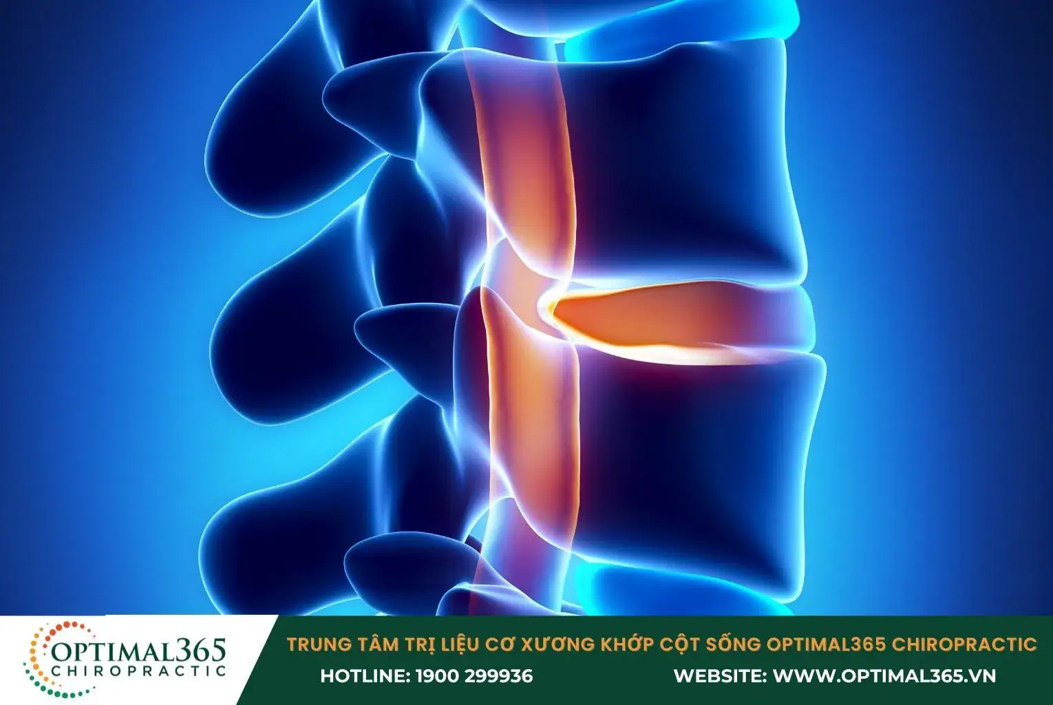 Hẹp ống sống xảy ra khi không gian trong ống sống bị thu hẹp, chèn ép thần kinh